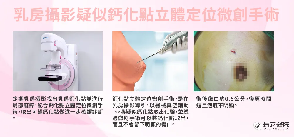 乳房攝影疑似鈣化點立體定位微創手術