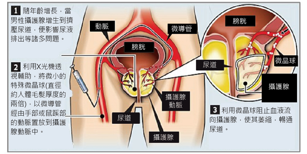 攝護腺動脈栓塞術(攝護腺減手術)