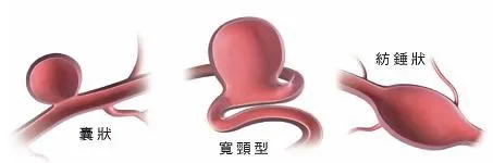 腦血管退化性疾病｜中風、動脈瘤、帕金森、腦部出血、代謝性腦病變