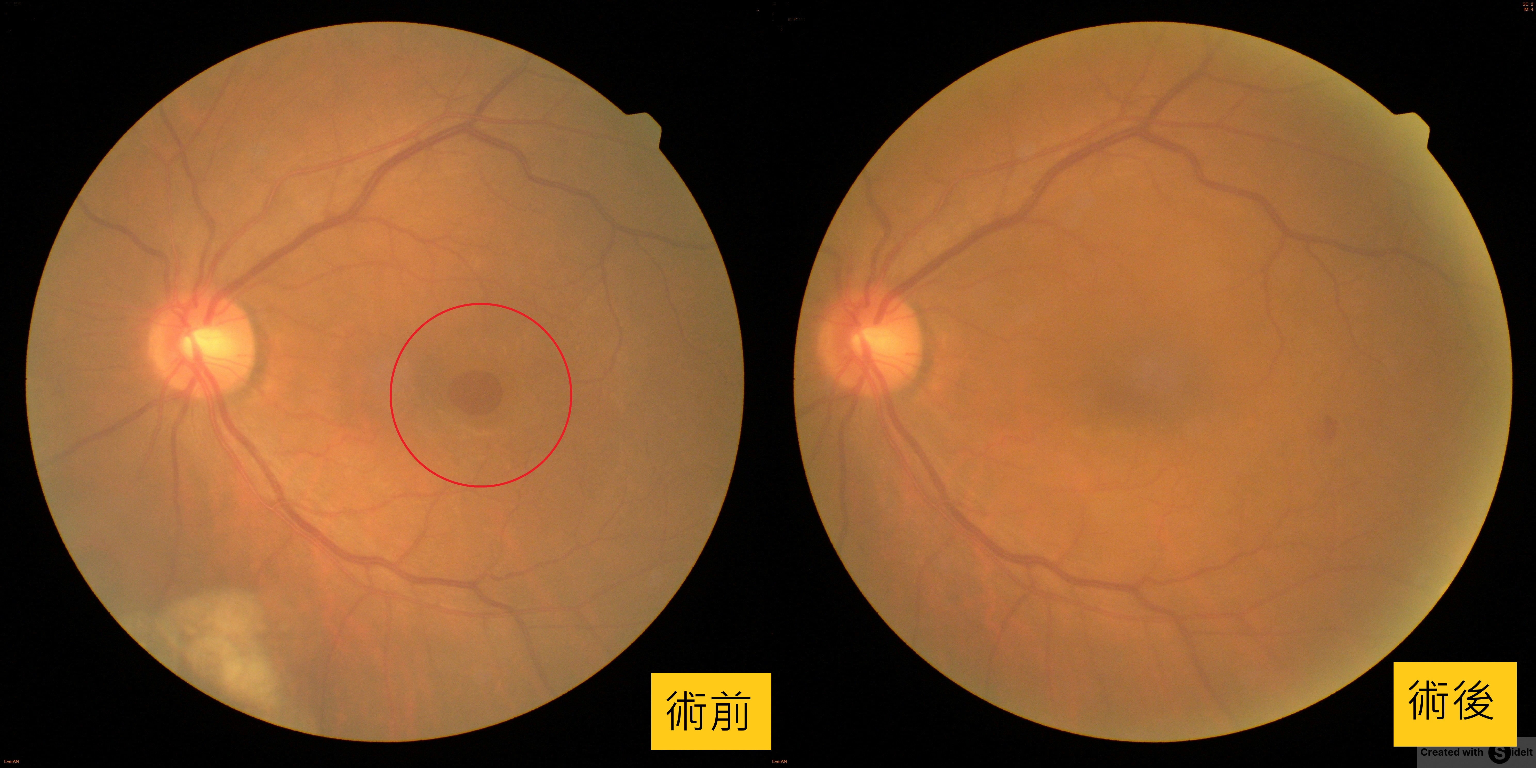 六旬翁眼前一團黑,竟是黃斑部破大洞! 六旬翁眼前一團黑,竟是黃斑部破大洞!