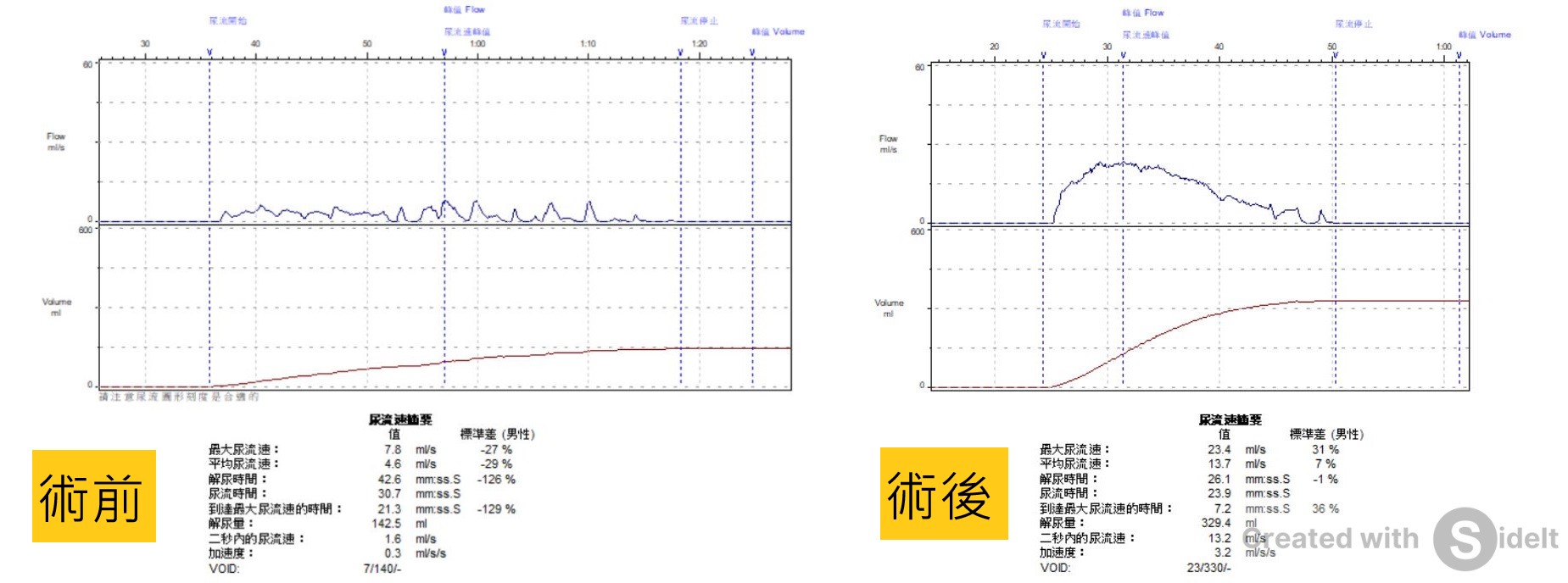 5旬男擺脫夜尿困擾 新型前列腺拉開術15分鐘見效