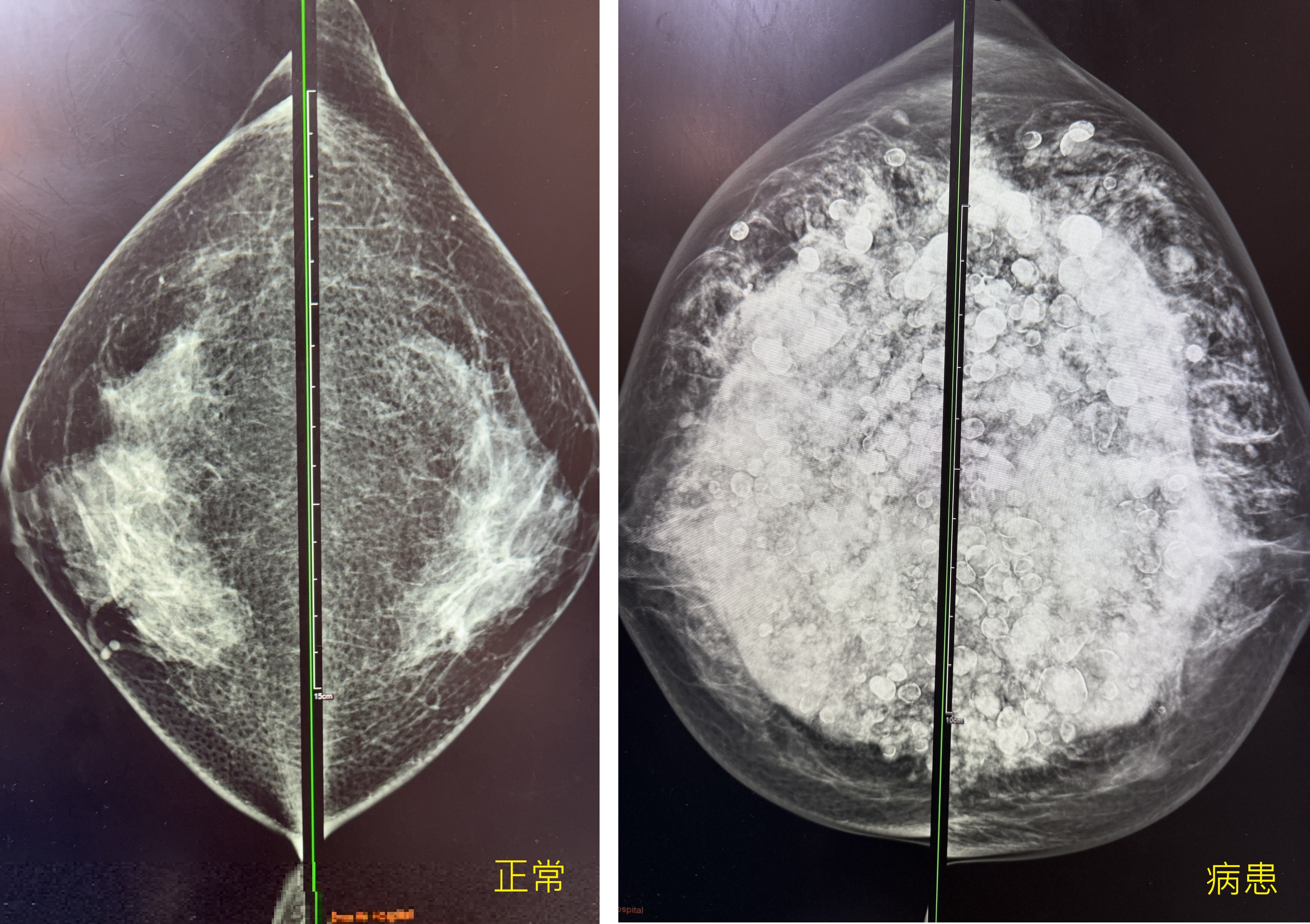 當年隆乳今全切！6旬婦乳房變形發臭 醫：小針隆乳恐致癌