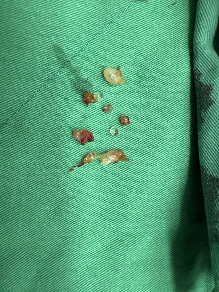 當年隆乳今全切！6旬婦乳房變形發臭 醫：小針隆乳恐致癌