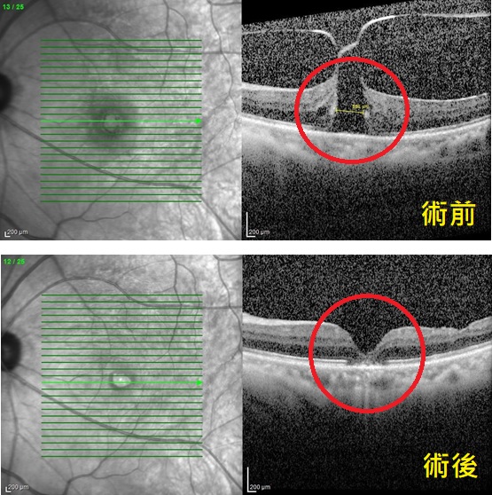 以為是白內障？真凶竟是黃斑部病變 醫：拖延恐失明
