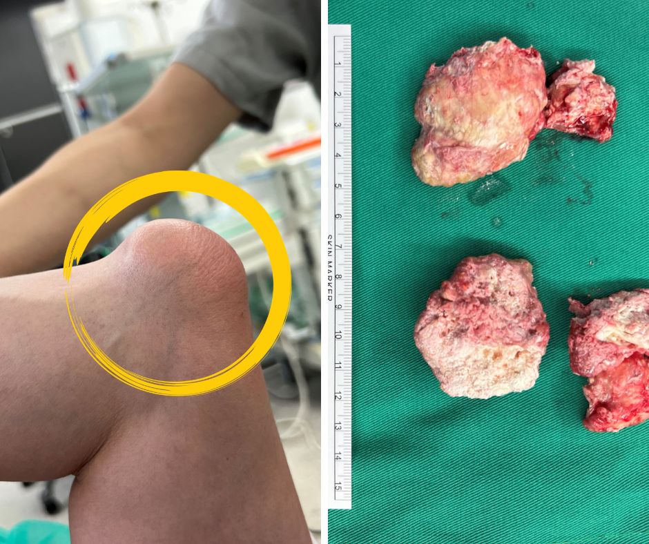 5旬男痛風石壓神經釀手麻！微創手術清石助好眠 醫：4狀況及早治