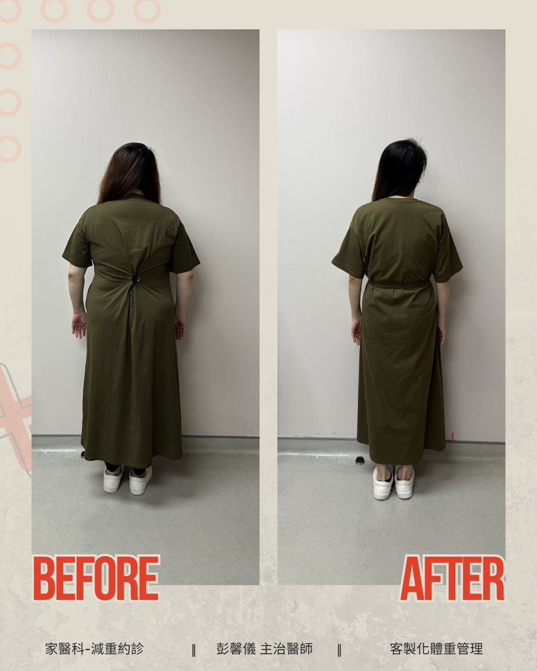 38歲女教師減重逾30公斤卻狂掉髮　醫提醒：瘦身別把營養也瘦掉