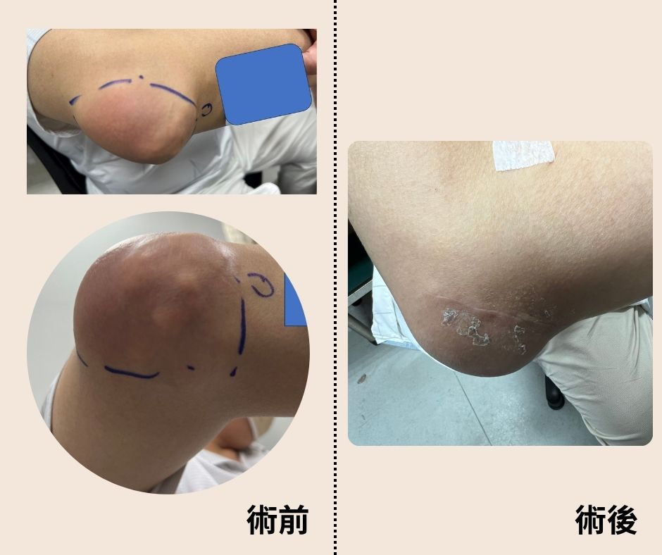 手肘痛風石手術像開盲盒，1顆變10幾顆！醫提三招保關節