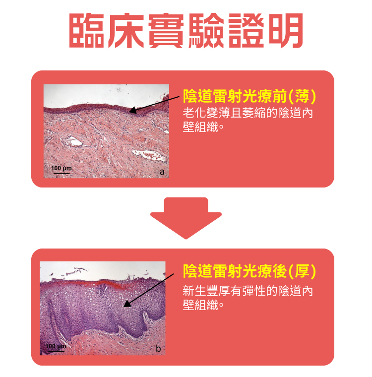 陰道雷射治療-蒙娜麗莎之吻｜長安醫院