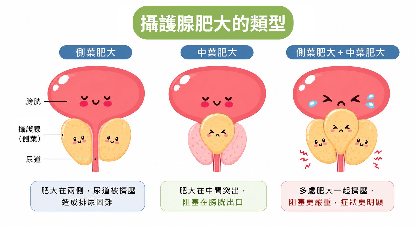 攝護腺肥大治療：告別排尿困擾，重拾順暢人生｜長安醫院泌尿科
